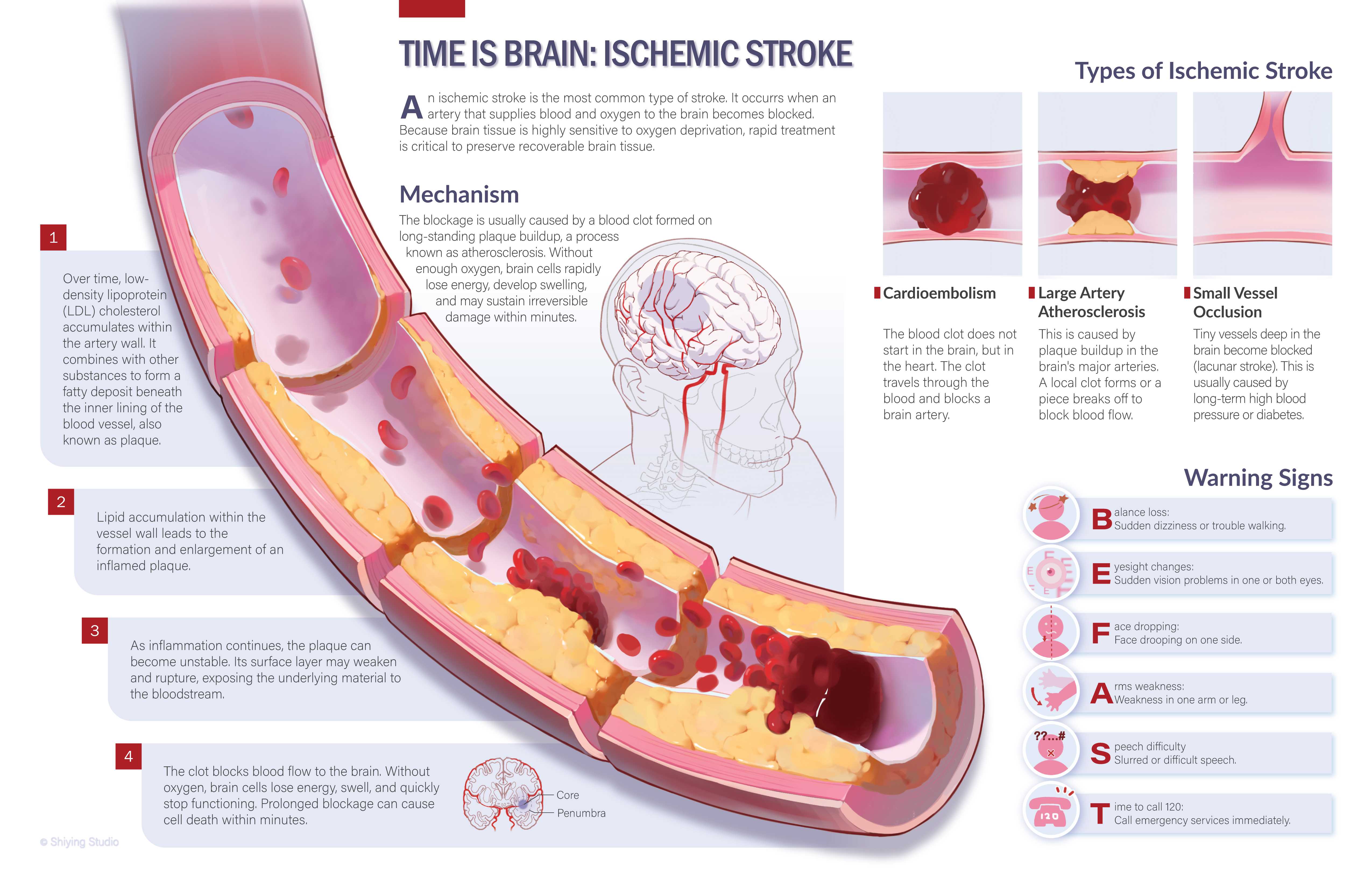 Ischemic Stroke