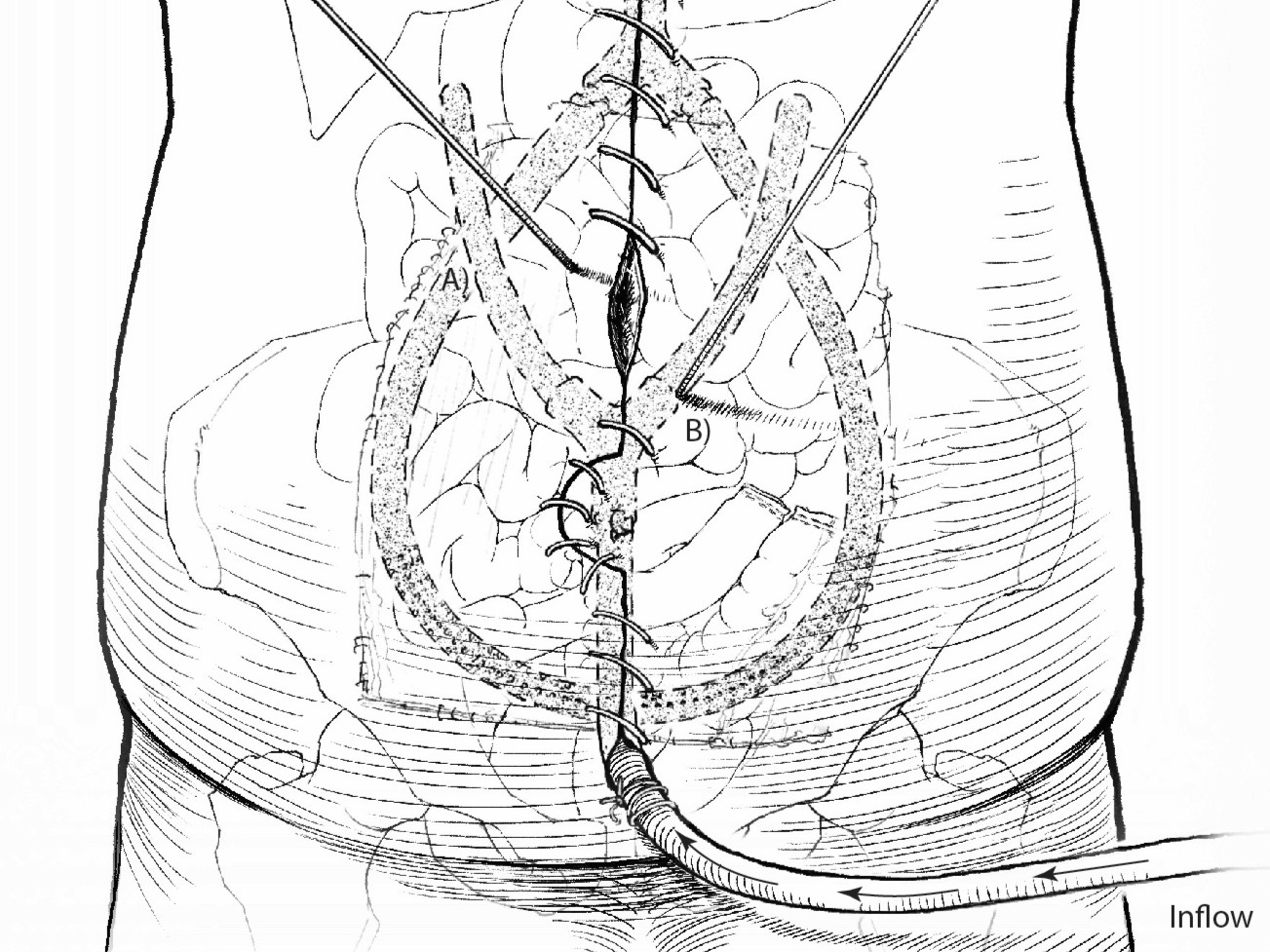 Surgical Illustration